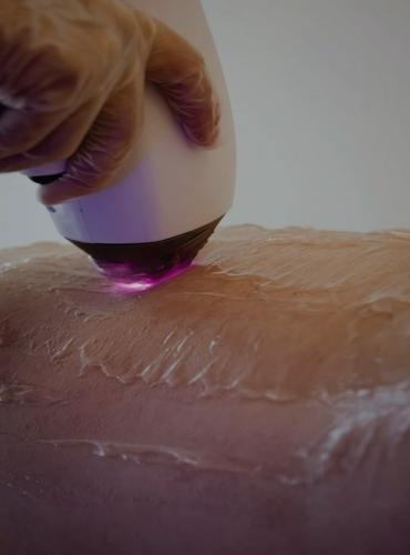 epilation2 resized